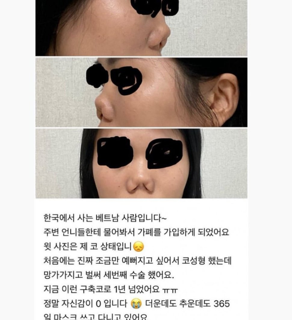 한국에서 코 성형한 베트남 사람 | 인스티즈