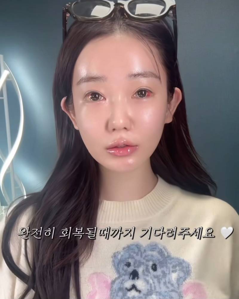 현재 여론 살벌한 눈동자 성형수술.JPG (충격주의) | 인스티즈