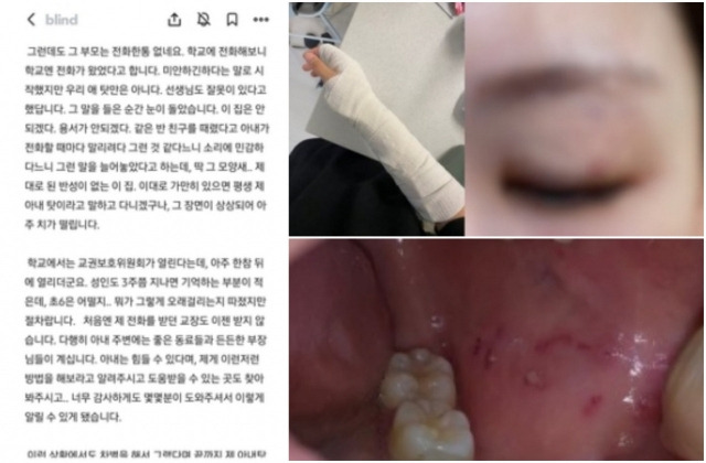 6학년男 발길질에 피멍 든 '전치 3주' 女교사, 학부모 상대로 소송전 | 인스티즈